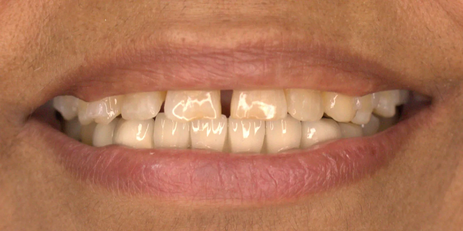 Full Mouth Rehabilitation — after treatment
