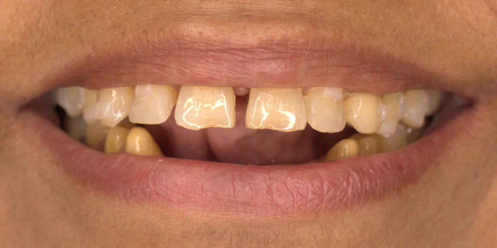 Full Mouth Rehabilitation — before treatment