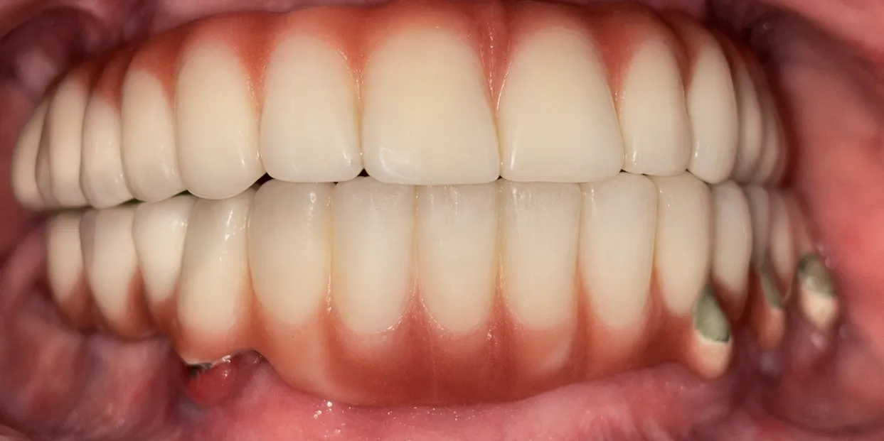 Implant-Supported Prosthesis — after treatment