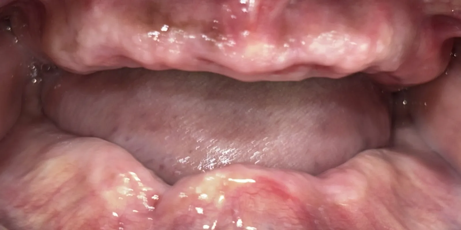 Implant-Supported Prosthesis — before treatment