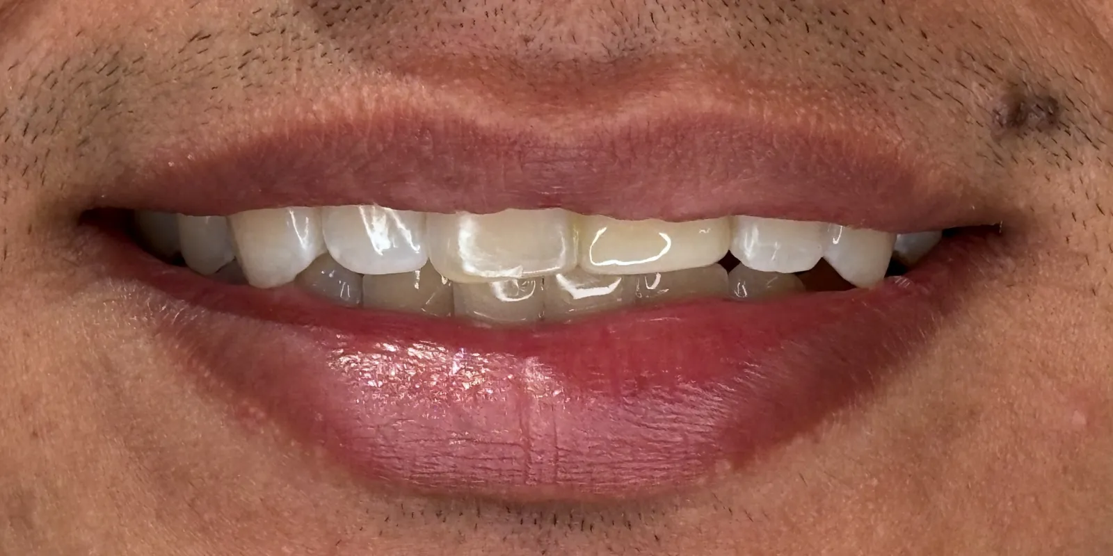 Smile Design — after treatment