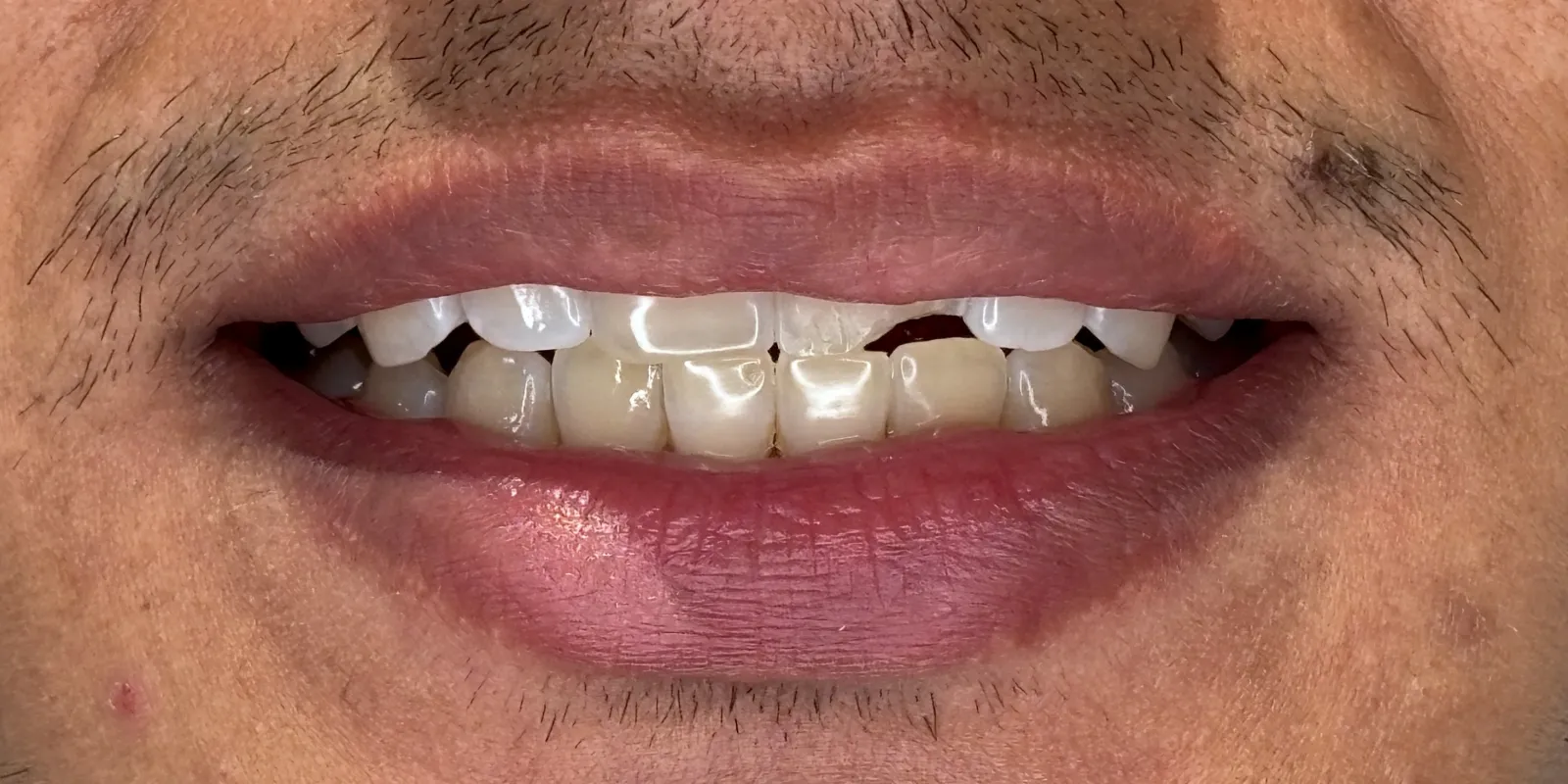 Smile Design — before treatment
