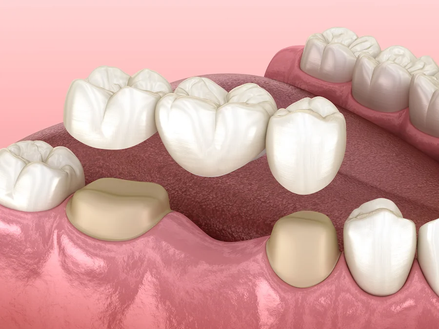 Dental Crowns & Bridges
